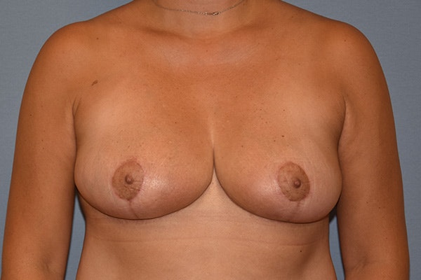 Breast Reduction Before & After Gallery - Patient 142129 - Image 2