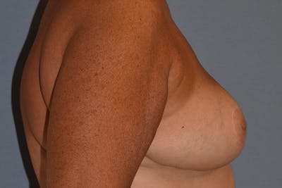 Breast Reduction Before & After Gallery - Patient 148956 - Image 6