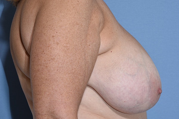 Breast Reduction Before & After Gallery - Patient 148956 - Image 5