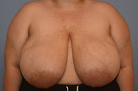 Breast Reduction Before & After Gallery - Patient 421887 - Image 1