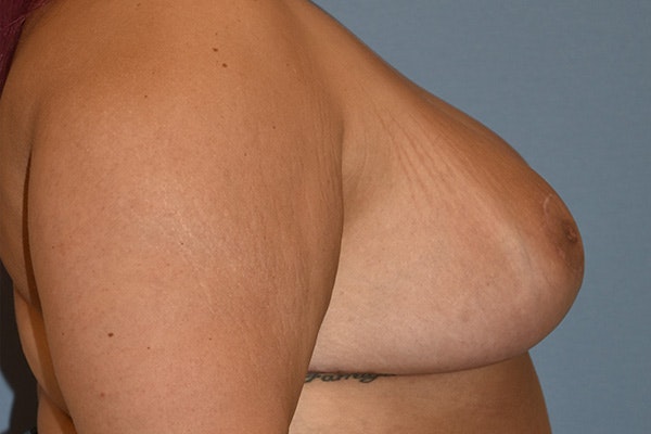 Breast Reduction Before & After Gallery - Patient 421887 - Image 6