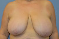 Breast Reduction Before & After Gallery - Patient 271278 - Image 1