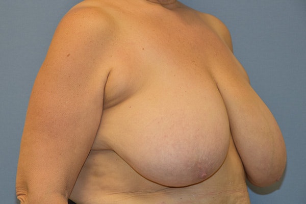 Breast Reduction Before & After Gallery - Patient 271278 - Image 3