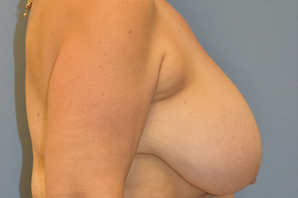 Breast Reduction Before & After Gallery - Patient 271278 - Image 5