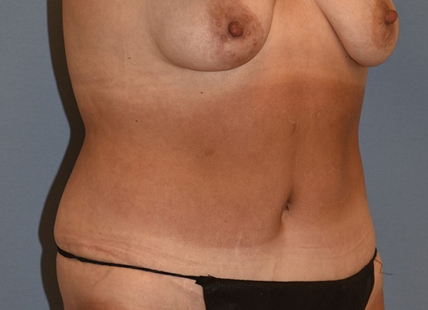 Liposuction Before & After Gallery - Patient 820804 - Image 3