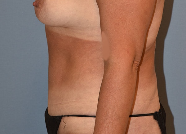 Liposuction Before & After Gallery - Patient 820804 - Image 9