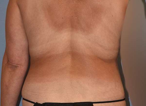Liposuction Before & After Gallery - Patient 820804 - Image 11