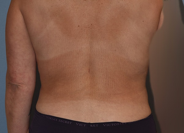 Liposuction Before & After Gallery - Patient 820804 - Image 12