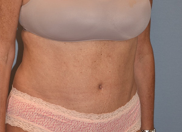 Liposuction Before & After Gallery - Patient 491621 - Image 4