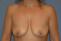 Breast Lift Before & After Gallery - Patient 169616 - Image 1