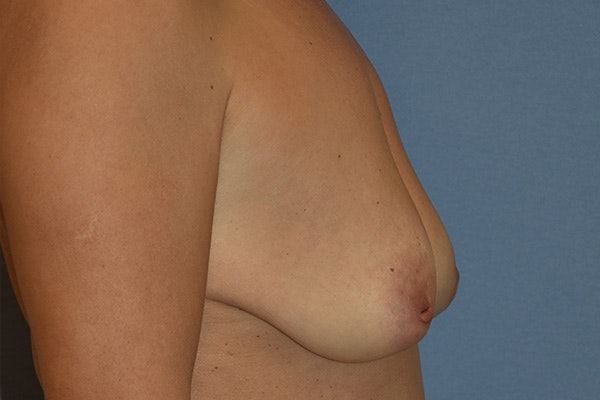 Breast Lift Before & After Gallery - Patient 169616 - Image 5