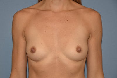 Breast Augmentation Before & After Gallery - Patient 434606 - Image 1