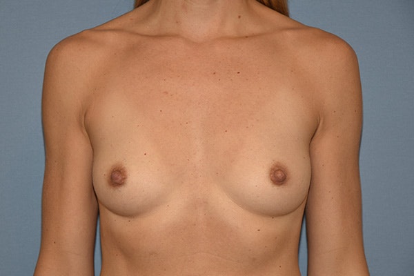 Breast Augmentation Before & After Gallery - Patient 434606 - Image 1