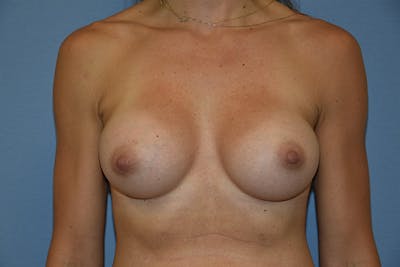 Breast Augmentation Before & After Gallery - Patient 434606 - Image 2