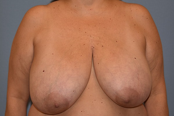 Breast Reduction Before & After Gallery - Patient 291600 - Image 1