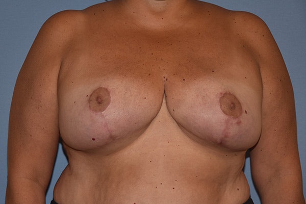 Breast Reduction Before & After Gallery - Patient 291600 - Image 2