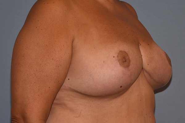 Breast Reduction Before & After Gallery - Patient 291600 - Image 4
