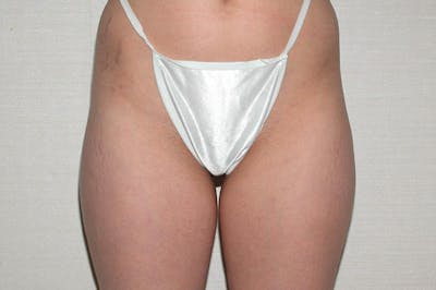 Liposuction Before & After Gallery - Patient 345823 - Image 1