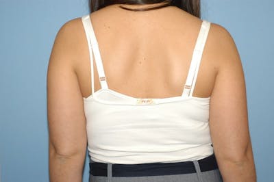 Liposuction Before & After Gallery - Patient 401853 - Image 1