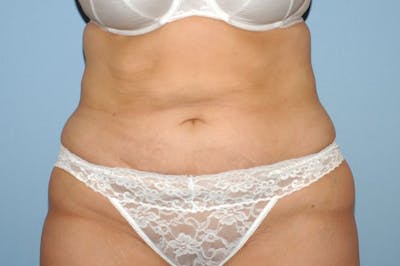 Liposuction Before & After Gallery - Patient 174030 - Image 2