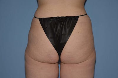 Liposuction Before & After Gallery - Patient 216336 - Image 1