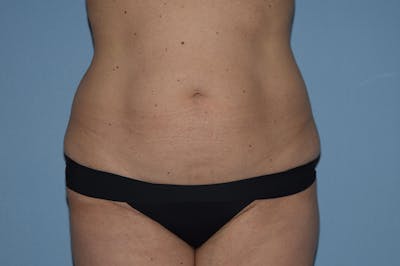 Liposuction Before & After Gallery - Patient 703687 - Image 1