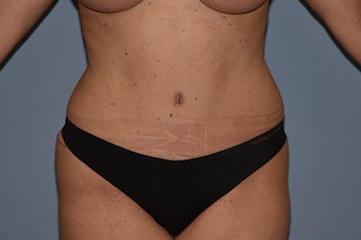 Liposuction Before & After Gallery - Patient 703687 - Image 2