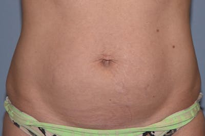 Liposuction Before & After Gallery - Patient 391136 - Image 1