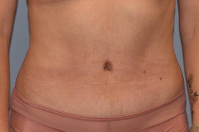 Liposuction Before & After Gallery - Patient 391136 - Image 2