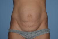Tummy Tuck Before & After Gallery - Patient 273161 - Image 1