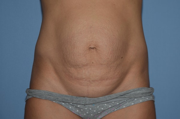 Before and After Abdominoplasty in Long Island