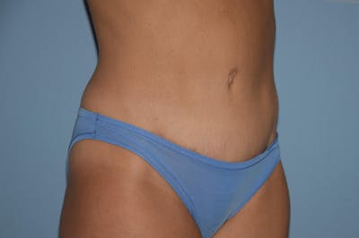 Tummy Tuck Before & After Gallery - Patient 273161 - Image 4