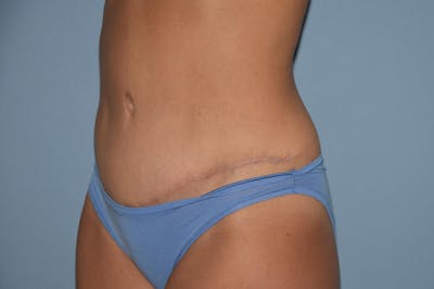 Tummy Tuck Before & After Gallery - Patient 273161 - Image 8
