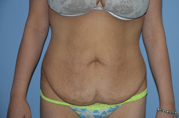 Before and After Abdominoplasty in Long Island