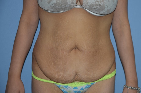 Tummy Tuck Before & After Gallery - Patient 121457 - Image 1