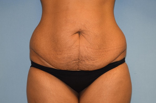 Tummy Tuck Before & After Gallery - Patient 139527 - Image 1
