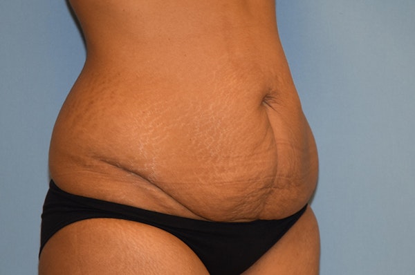 Tummy Tuck Before & After Gallery - Patient 139527 - Image 3