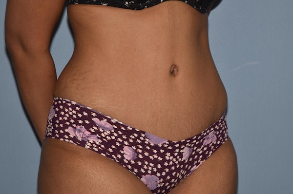 Tummy Tuck Before & After Gallery - Patient 139527 - Image 4