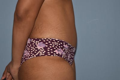 Tummy Tuck Before & After Gallery - Patient 139527 - Image 6