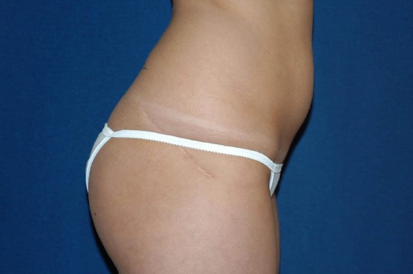 Liposuction Before & After Gallery - Patient 264676 - Image 3