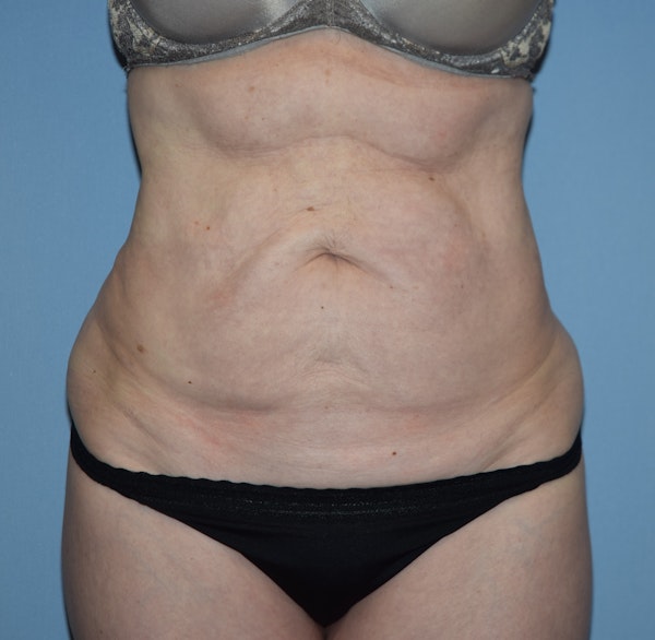 Tummy Tuck Before & After Gallery - Patient 777381 - Image 1