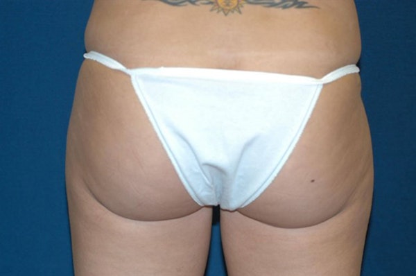 Liposuction Before & After Gallery - Patient 264676 - Image 5