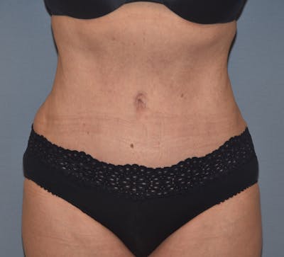 Tummy Tuck Before & After Gallery - Patient 777381 - Image 2