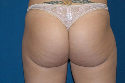 Liposuction Before & After Gallery - Patient 264676 - Image 6