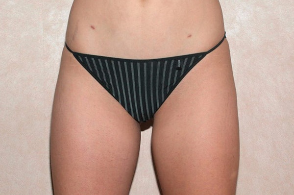 Liposuction Before & After Gallery - Patient 368731 - Image 2