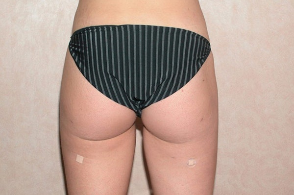 Liposuction Before & After Gallery - Patient 368731 - Image 4