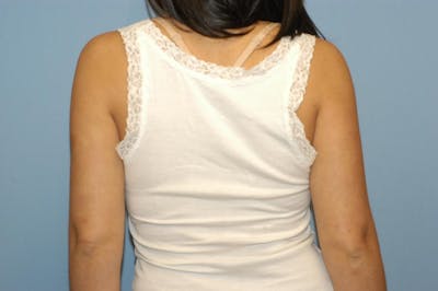 Liposuction Before & After Gallery - Patient 382930 - Image 2