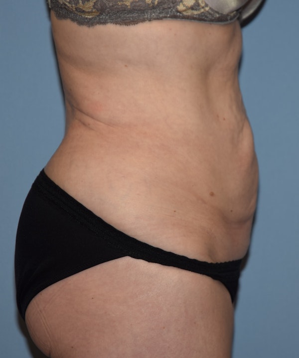 Tummy Tuck Before & After Gallery - Patient 777381 - Image 5