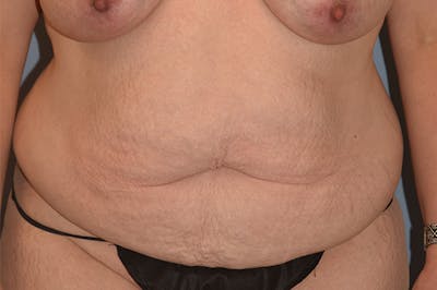 Mommy Makeover Before & After Gallery - Patient 193465 - Image 1