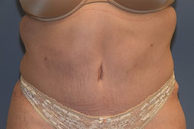 Mommy Makeover Before & After Gallery - Patient 193465 - Image 2